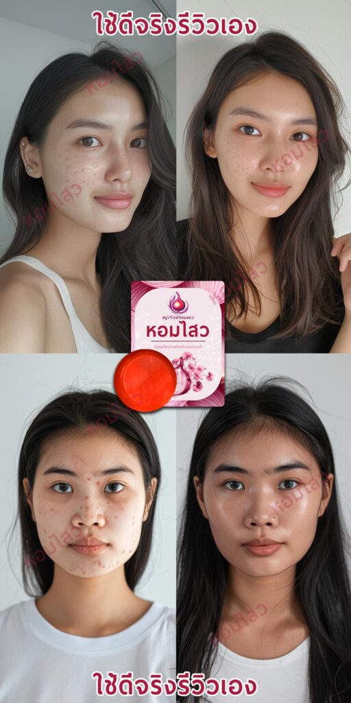 รีวิวสบู่ลดสิว ลดฝ้า - สบู่หอมไสว
