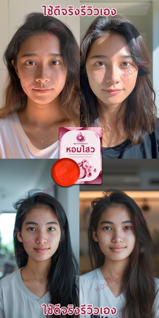 รีวิวสบู่ลดสิว ลดฝ้า - สบู่หอมไสว